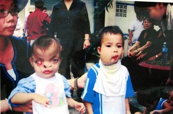 Two young ‘Agent Orange’ victims Two young ‘Agent Orange’ victims